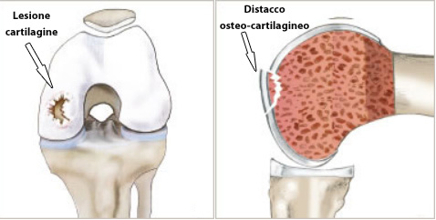 Lesione cartilagine ed osteocondrale ginocchio
