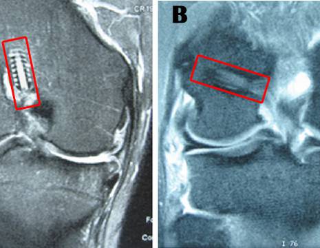 A. Erroneo posizionamento verticale del tunnel al femore. B. Corretta posizione anatomica del tunnel.jpg 1