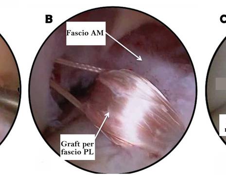 A Fascio postero-laterale (PL) lesionato. B passaggio del graft. C Aspetto in artroscopia dopo ricostruzione 1