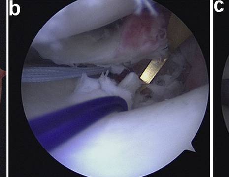 A) Lesione radice meniscale (root). B) riparazione con filo e guida dedicata. C) radice riparata 1