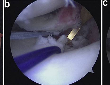 A Lesione radice meniscale _root_. B riparazione con filo e guida dedicata. C radice riparata.jpg 1