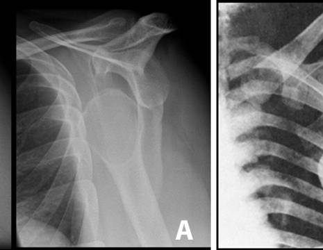 A. Classica lussazione anteriore di spalla.    B. Rara lussazione intratoracica 1