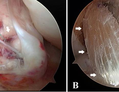 A crociato anteriore lesionato. B crociato anteriore ricostruito. Visione in artroscopia 1