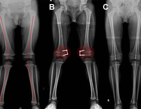 A ginocchio valgo in bambino. B intervento di emiepifisiodesi. C risultato finale.jpg 1