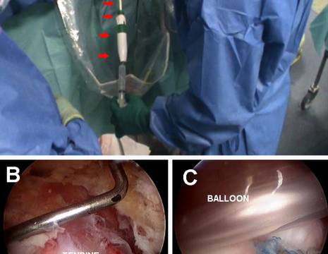 A introduttore palloncino Balloon. B visione artroscopica tendine riparato. C Balloon sopra il tendine riparato .jpg 1