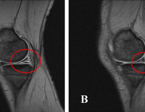 Rottura orizzontale del menisco interno e lesione degenerativa del menisco interno 1