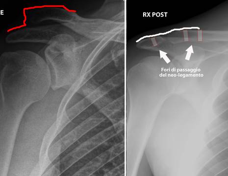 Alessio, radiografia prima e dopo l'intervento, da notare la scomparsa della salienza antomica 1