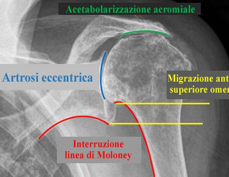 Alterazioni alla Rx possibili in una spalla pseudoparalitica 1