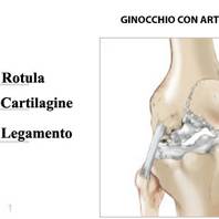 Protesi totale ginocchio - Dr Matteo Fosco