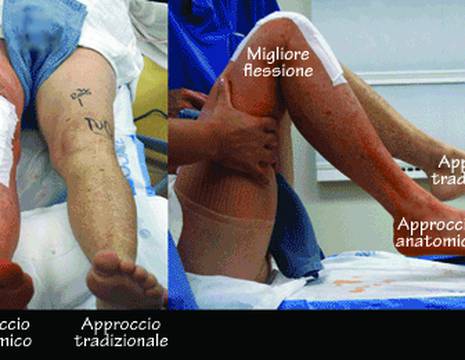 Approccio mininvasivo anatomico VS tradizionale 1