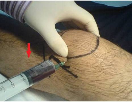 Aspirazione di EMARTRO dopo trauma al ginocchio 1