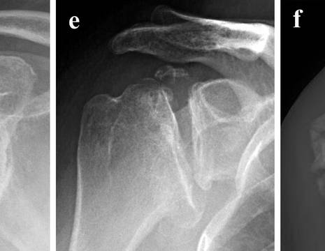 Artropatia spalla da artrite reumatoide (d), necrosi epifisi omerale (e), deformità post traumatica dell’omero prossimale 2