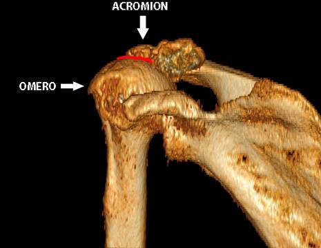 Artrosi alla spalla della signora Sandrina, estrema risalita dell'omero con acetabolarizzazione dell'acromion (in rosso) 1