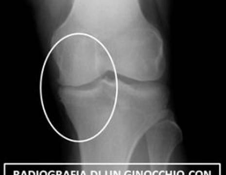 Artrosi monocompartimentale del ginocchio 1