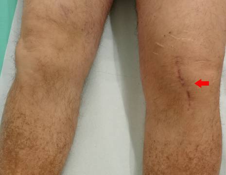 Aspetto del ginocchio dopo l'intervento, è stata ripresa la cicatrice presente dopo l'intervento di meniscectomia 1