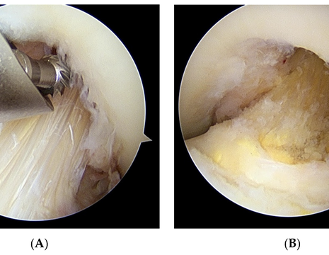 Intervento in artroscopia per legamento crociato con degenerazione mucoide. Prima (A) e dopo (B) escissione dei fasci sclerotici e plastica ossea 1