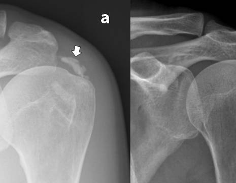 Calcificazione spalla in fase cronica (a) e fase acuta (b) 1