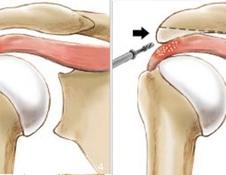 Calcificazione spalla schema intervento in artroscopia 1