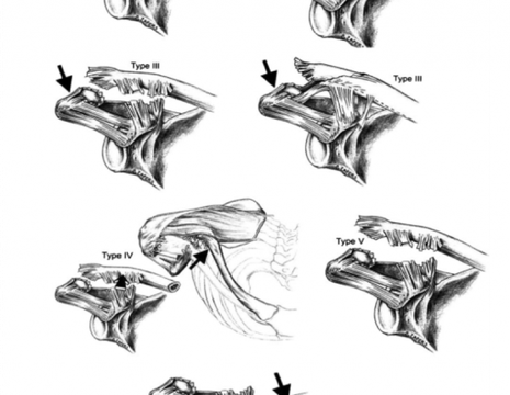 Classificazione Rockwood lussazione acromion-claveare 1