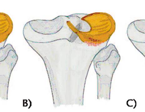 Classificazione di Watanabe del menisco discoide. A) tipo I; B) tipo II; C) tipo III 1