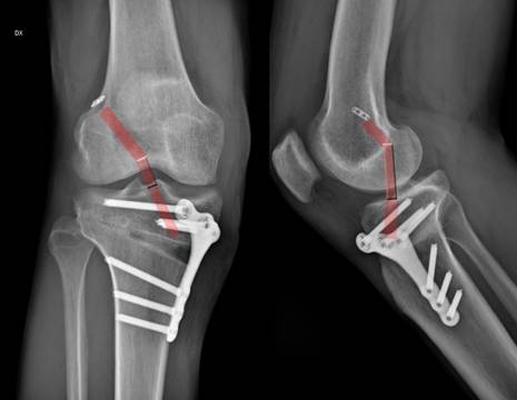 Contemporanea osteotomia e ricostruzione LCA di ginocchio. In rosso il decorso del legamento crociato anteriore ricostruito 1