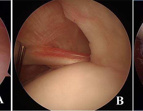 Diversi aspetti tendine bicipite. A tendine normale_ B infiammato_ C lesionato con infiammazione cronica.jpg 1