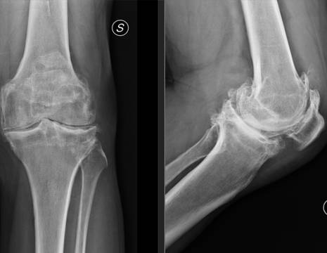 Domenico. Rx prima intervento protesi ginocchio.jpg 1