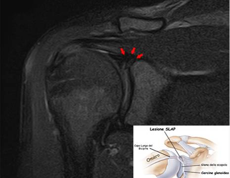 Elisa, lesione SLAP.jpg 1
