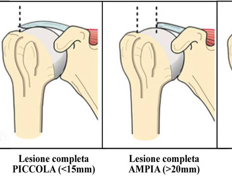 Evoluzione lesione cuffia dei rotatori.jpg 1