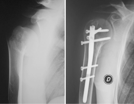 Frattura 2 frammenti dell'omero prossimale trattata con chiodo endomidollare 1