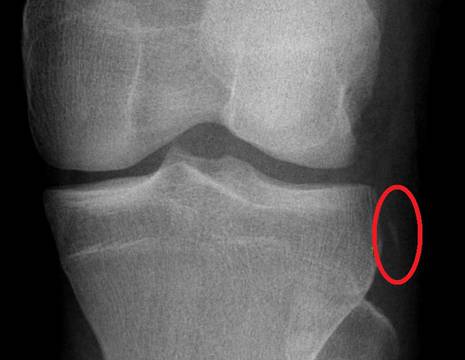 Frattura di Segond. Segno radiografico di lesione legamento crociato anteriore associato a lesione del legamento antero_laterale al ginocchio 1