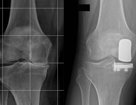 Ginocchio con artrosi mediale trattato con protesi monocompartimentale 1
