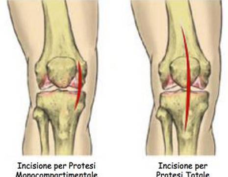 Incisioni comuni per un intervento di protesi al ginocchio 1