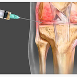 CELLULE MESENCHIMALI, FATTORI DI CRESCITA E NUOVE CURE PER ARTROSI AL GINOCCHIO. FACCIAMO CHIAREZZA