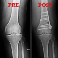 Intervento di osteotomia femorale