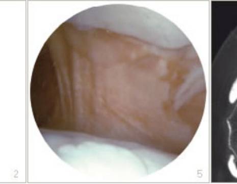 Iperpressione esterna della rotula. 5 Aspetto in artroscopia del legamento alare esterno. 6 Aspetto TC di iniziale artrosi da iperpressione rotula.jpg 1