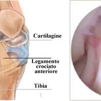 Lesione del legamento crociato anteriore