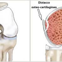 Lesioni della cartilagine del ginocchio