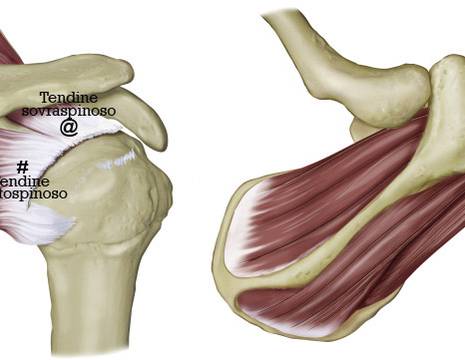 Lesione massiva cuffia rotatori coinvolge 2 tendini 1