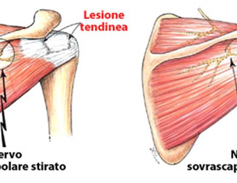 Lesione nervo sovrascapolare da rottura cuffia rotatori alla spalla.jpg 1