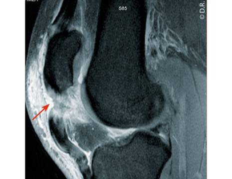 Lesione tendine rotuleo alla RMN 1