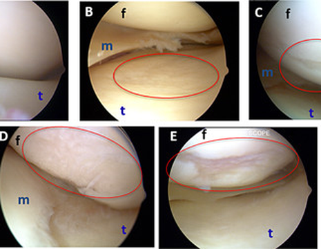 Diverse lesioni cartilagine al ginocchio. ​f Femore; t Tibia; m Menisco. A Cartilagine normale. C Erosione di poco spessore. E Esposizione ossea 1