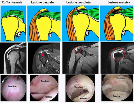 Lesioni cuffia dei rotatori aspetto RMN e visione in artroscopia 1