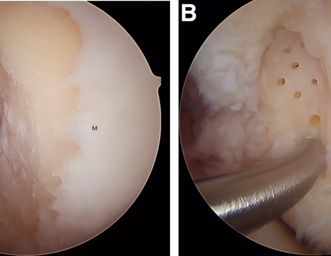 Microfratture per OCD. A regolarizzazione margini della lesione. B microperforazioni con strumento dedicato. M condilo femorale mediale 1