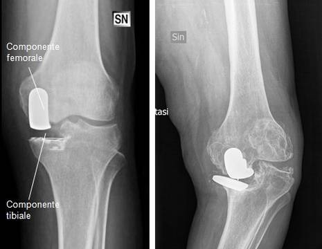 A sinistra protesi parziale (o monocompartimentale) dopo l'intervento, a destra mobilizzazione della protesi dopo qualche anno 1