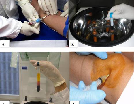 Modalità di preparazione PRP: A. Prelievo di sangue; B. Centrifugazione del sangue; C. Estrazione del PRP; D. Iniezione nella zona malata 1