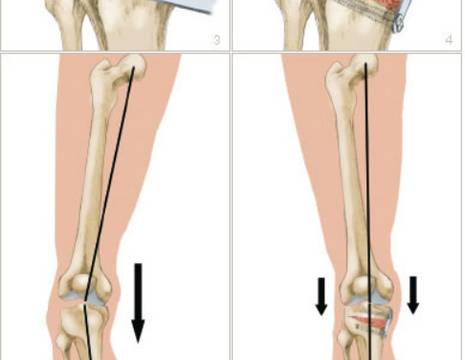 Osteotomia tibiale valgizzante 1