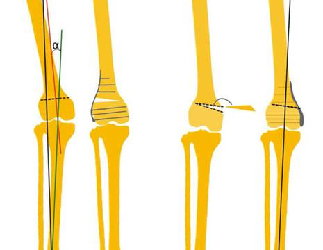 Osteotomia al femore in addizione ed in sottrazione.jpg 1