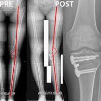Intervento di osteotomia tibiale valgizzante