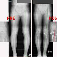 Intervento di osteotomia tibiale valgizzante